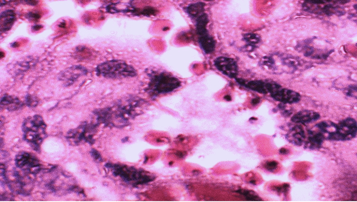 Placental blood smear with Plasmodium falciparum