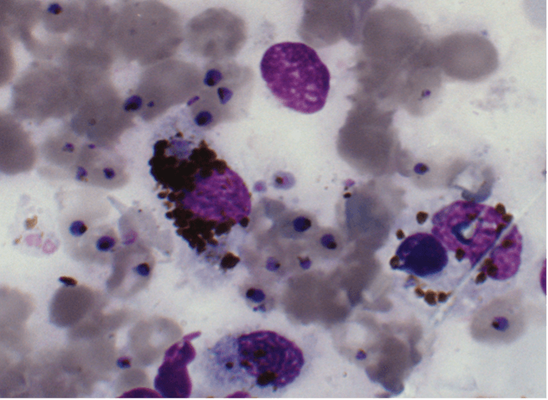 Placental blood smear with chronic placental malaria features
