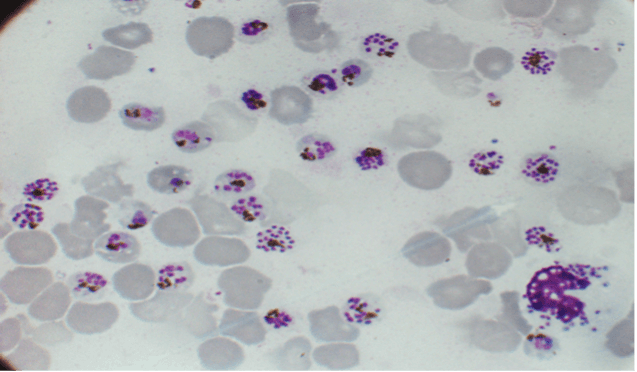 Histological section of placental tissue showing maternal-foetal interface